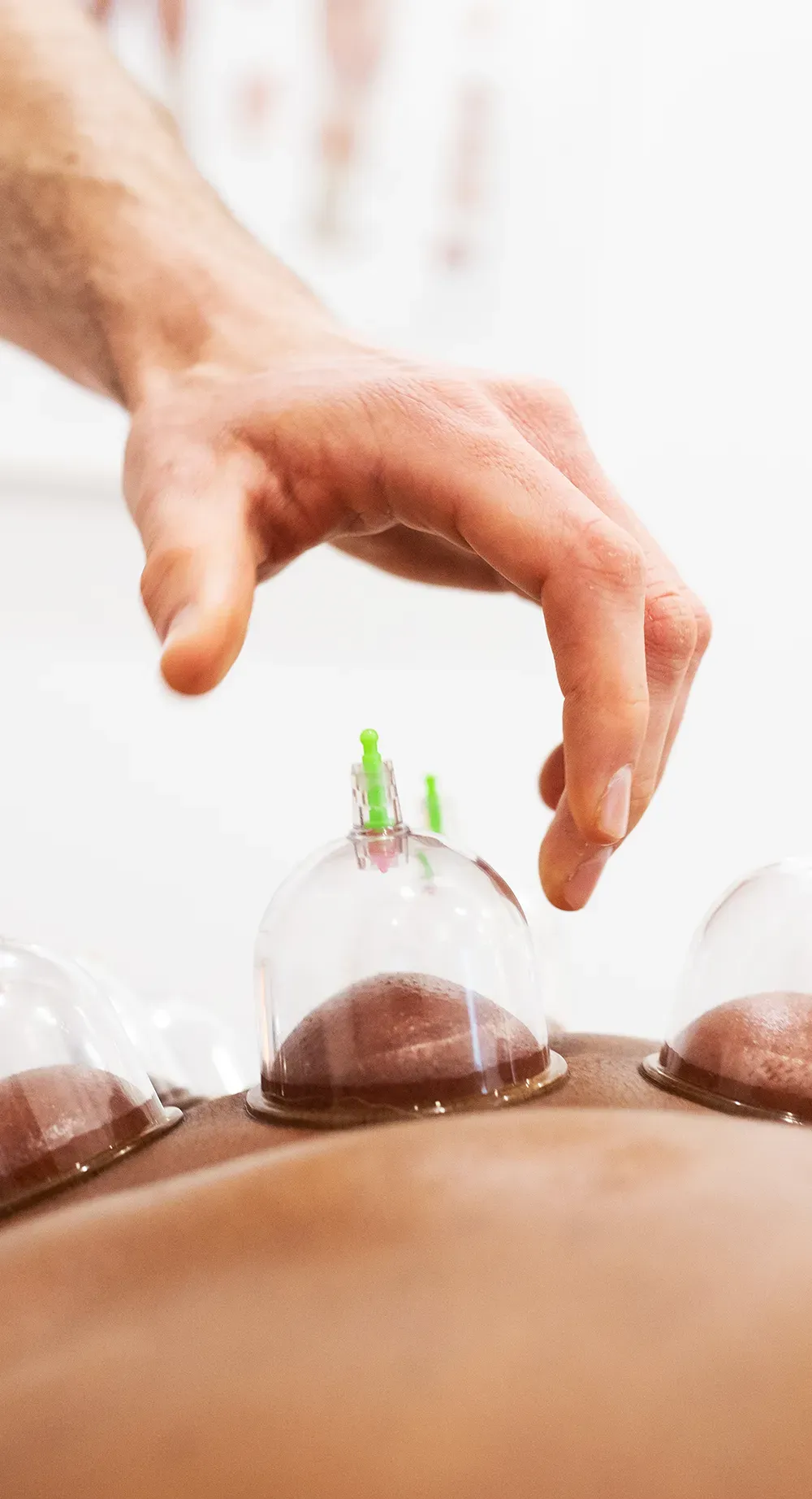cupping-therapy-application-ventouses-peau Cupping the skin during a cupping therapy session, showing the practitioner's hand adjusting the transparent plastic cups for a wellness therapy.